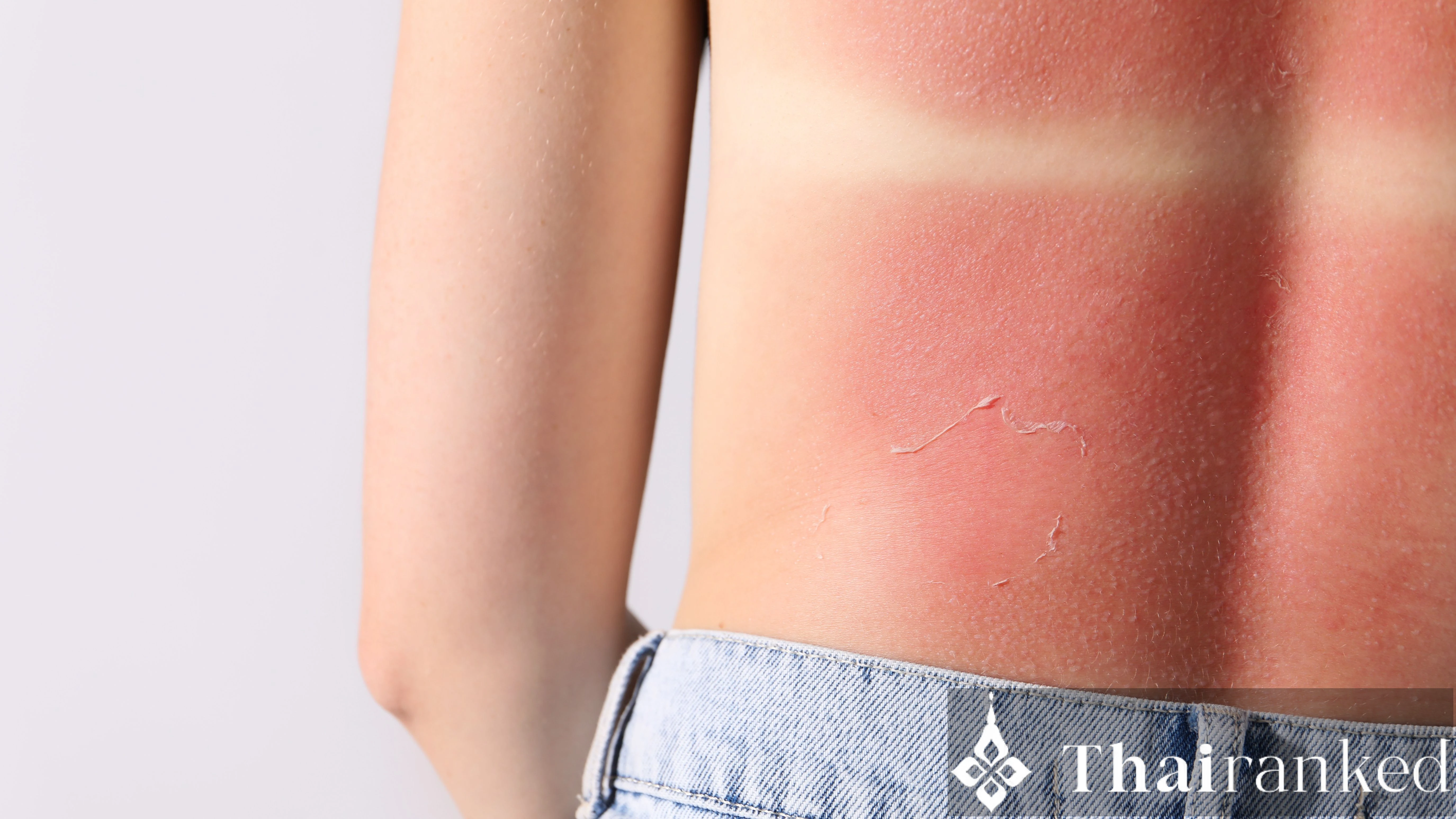 How to Treat "Pung" (Heat Rash) in Thailand